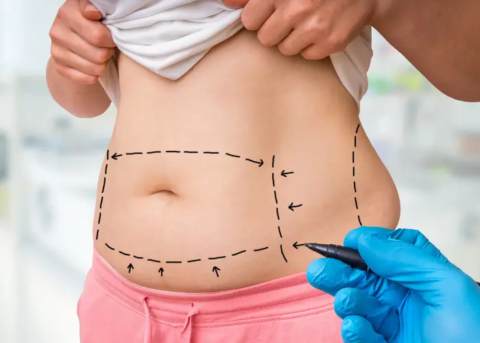 Liposuction Surgery in Mumbai vs Weight Loss Surgery- featured image