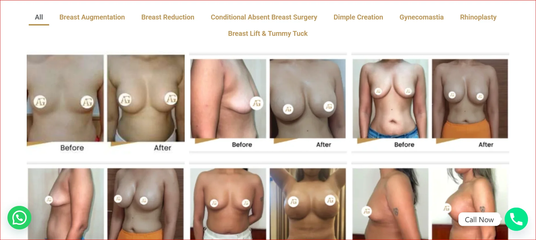 Breast implant surgery in Mumbai Before After