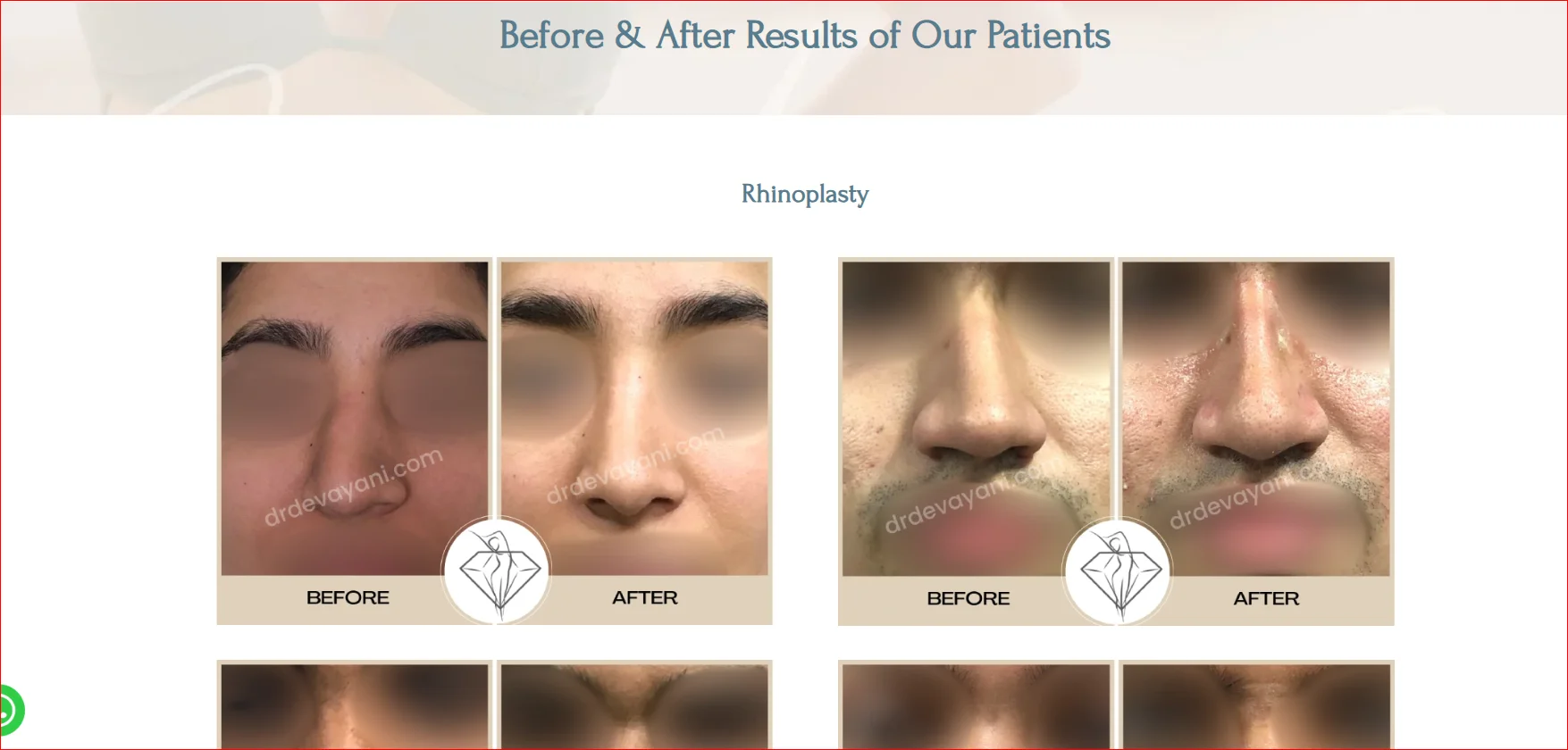 Rhinoplasty Before and After Results