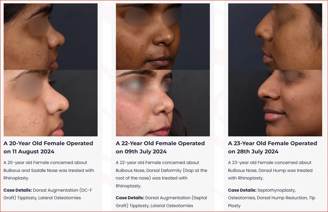 Rhinoplasty Before and After Case Study