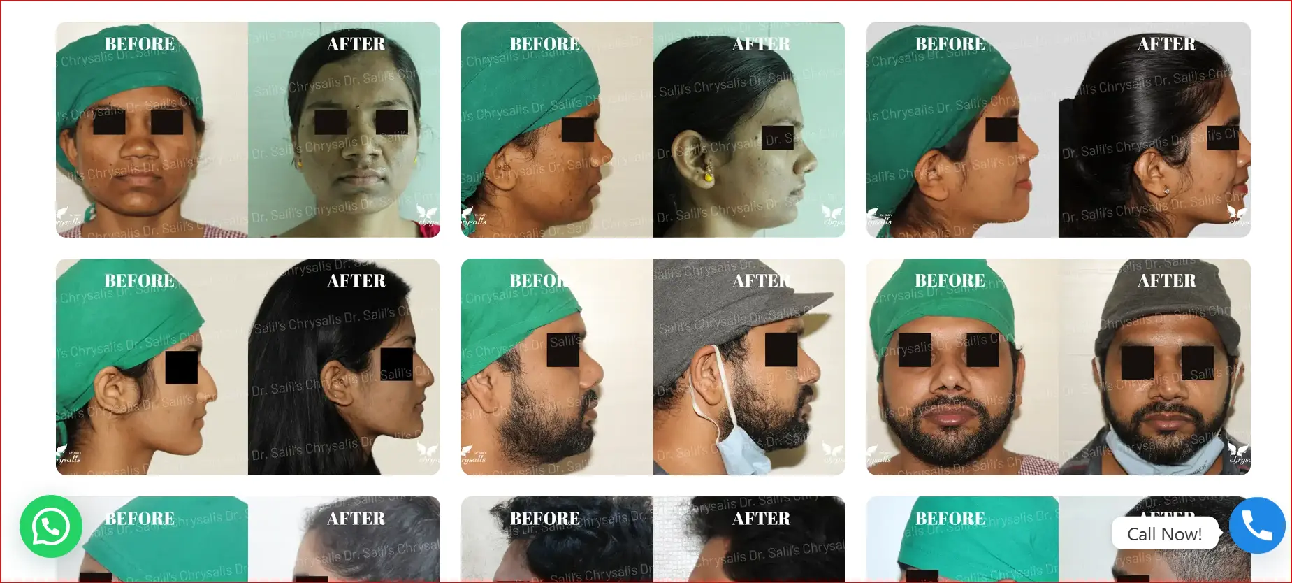 Rhinoplasty Before and After Cases