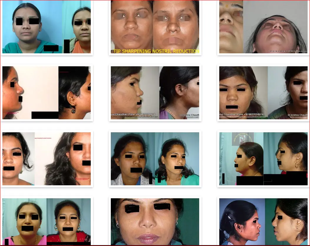 Rhinoplasty Before and After Results Gallery