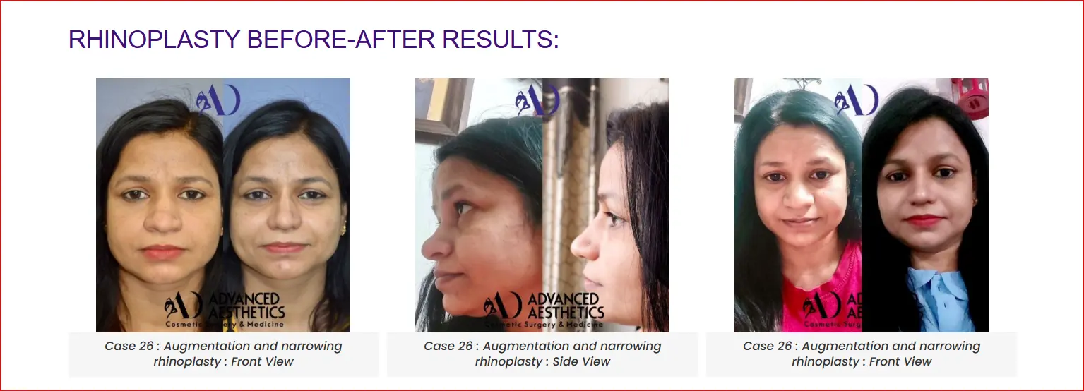 Rhinoplasty Patient Testimonial Review