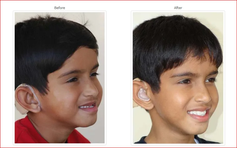 Before-After Smile Design with Aligner Treatment