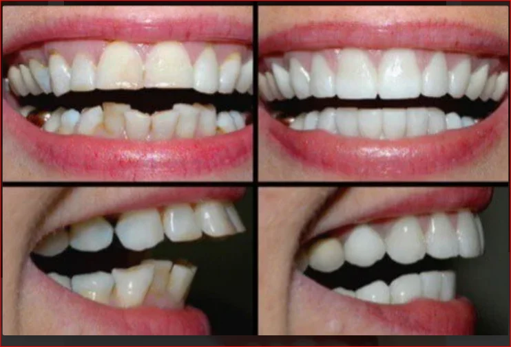 Before-After Smile Makeover Case