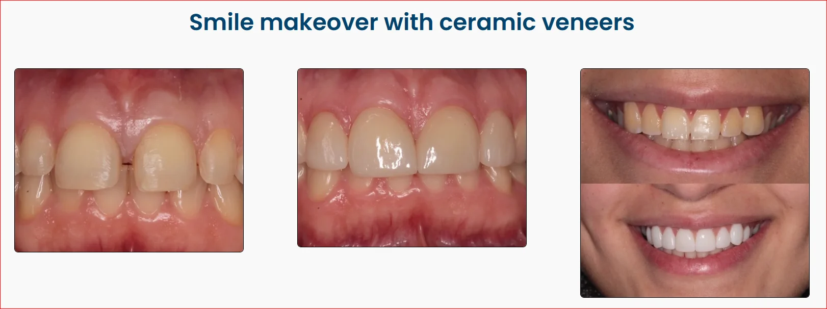 Smile Makeover with Ceramic Veneers